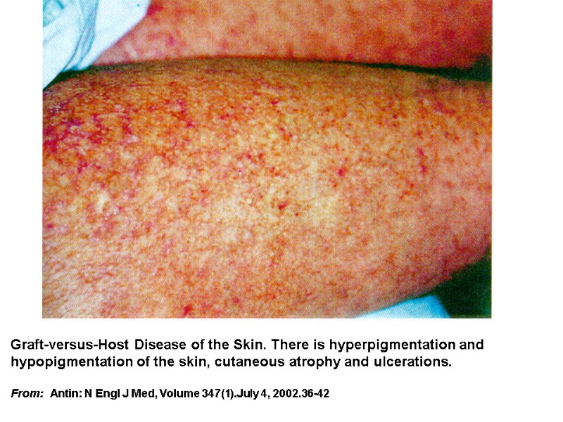 Graft-versus-Host Disease of the Skin. There is hyperpigmentation and hypopigmentation of the skin, cutaneous